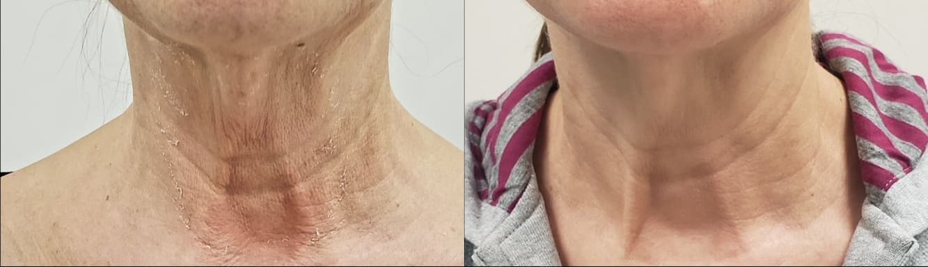 Before and after: neck skin tightening and texture