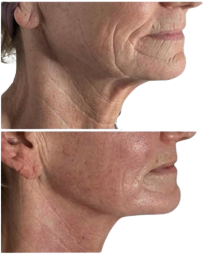 Before and after: non-surgical neck and jawline tightening at Pureté