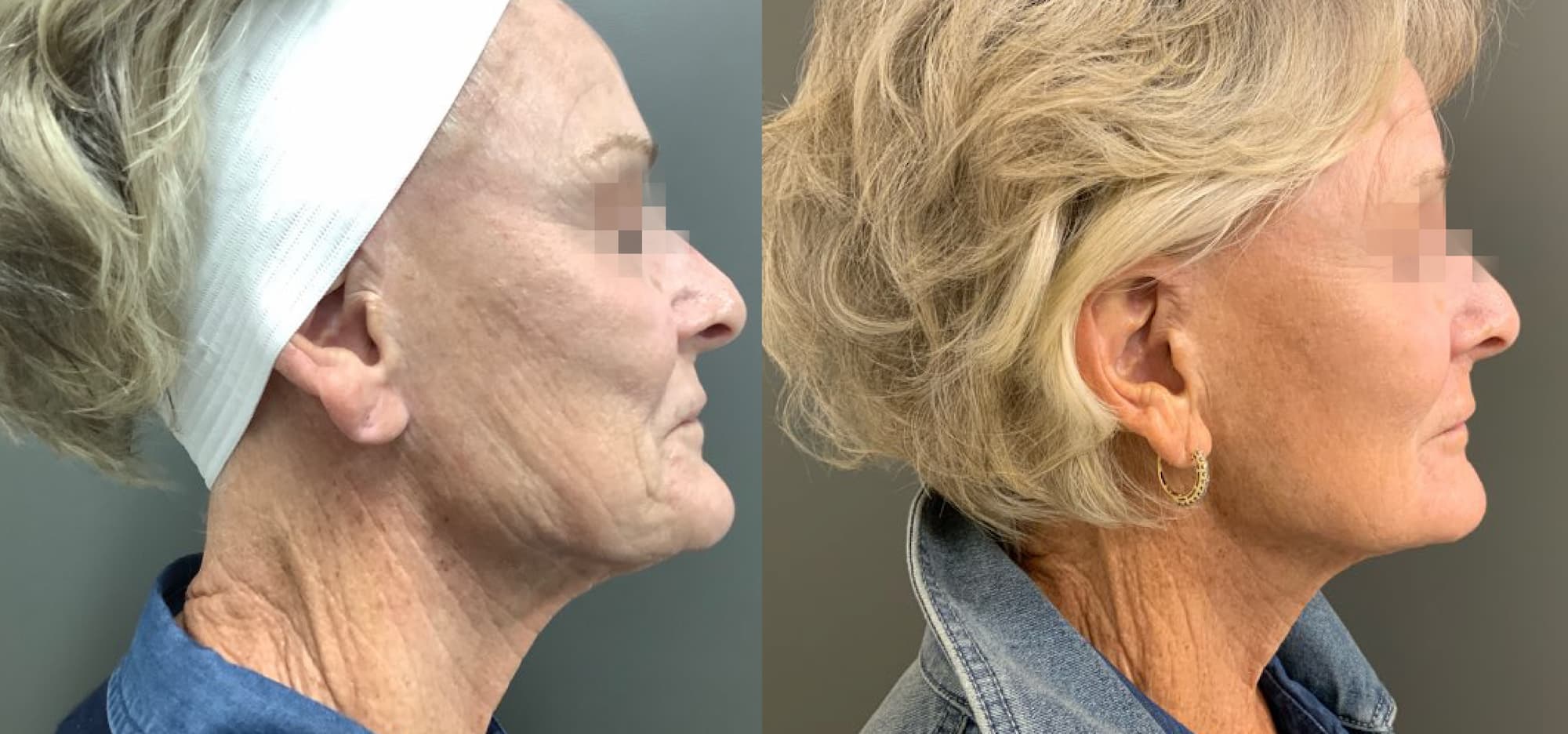 Before and after: lower face and neck tightening, side profile
