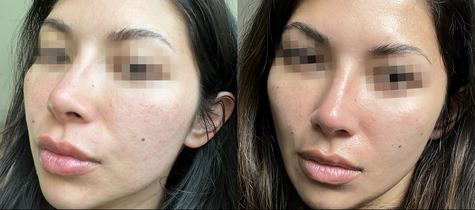Before and after: refined cheek texture and pore appearance