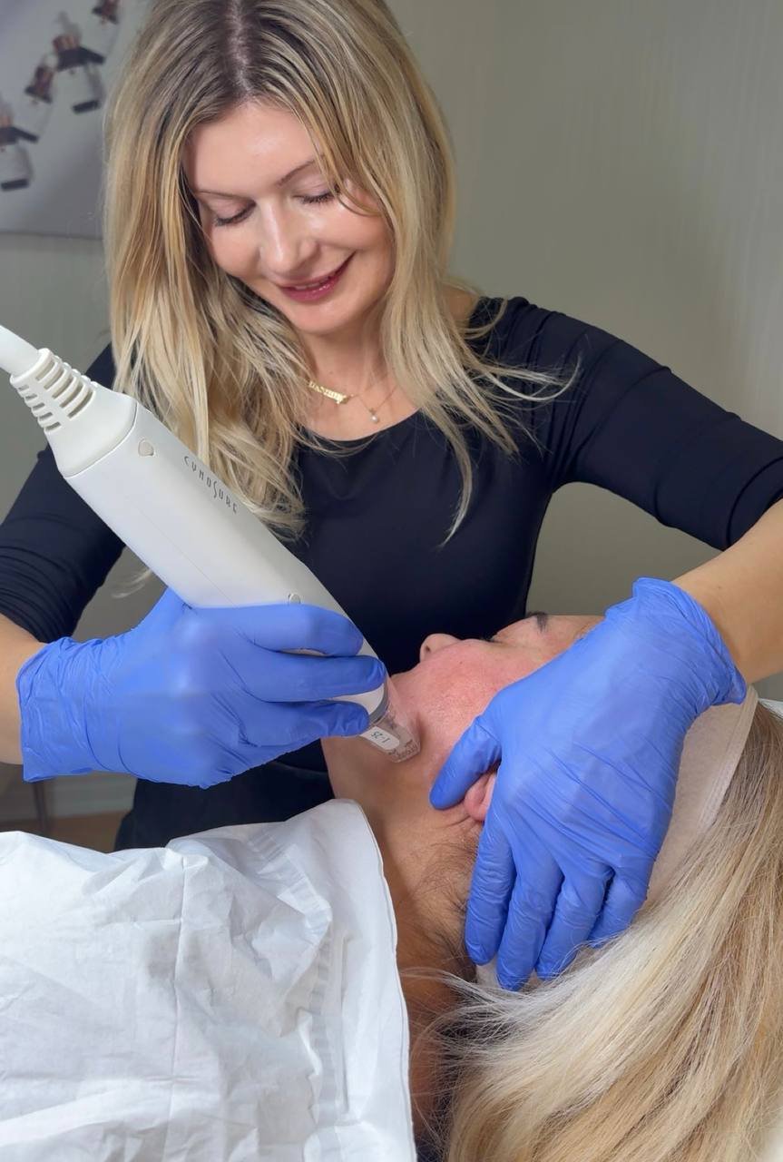 Potenza RF microneedling treatment by a Pureté nurse in our Etobicoke clinic